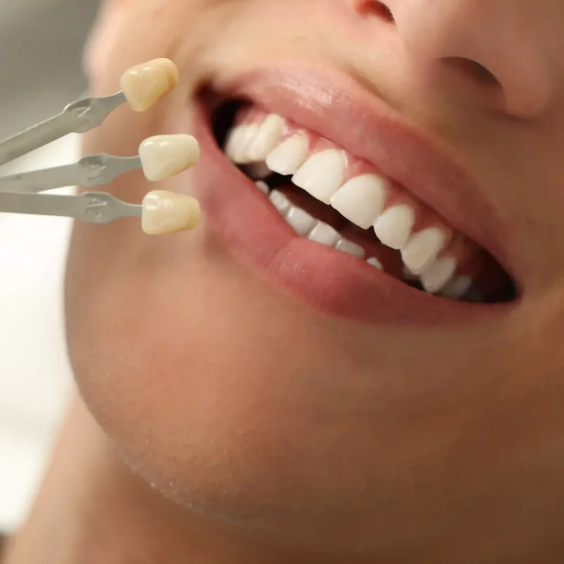 doctor-checking-young-man39s-teeth-color-clinic-closeup-dental-veneers-ezgif.com-optiwebp